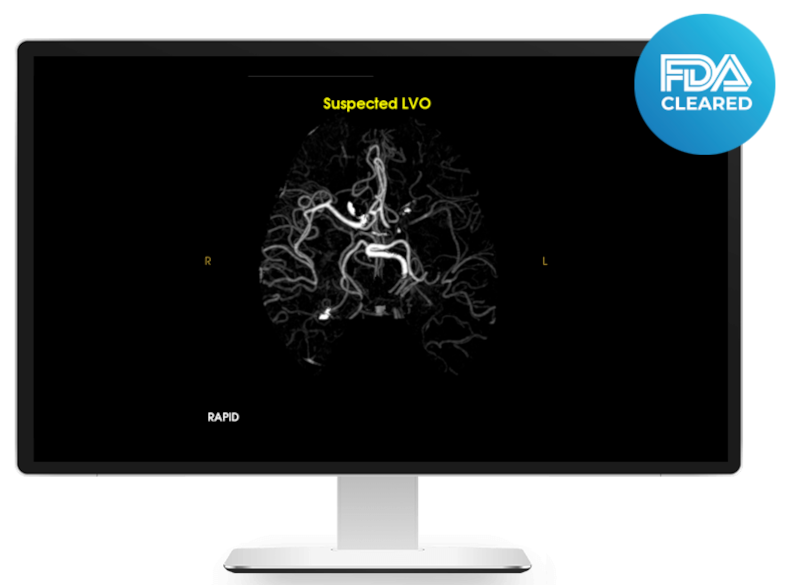 RAPID-AI technology facilitates fast identification of suspected LVOs to streamline triage and transfer decisions