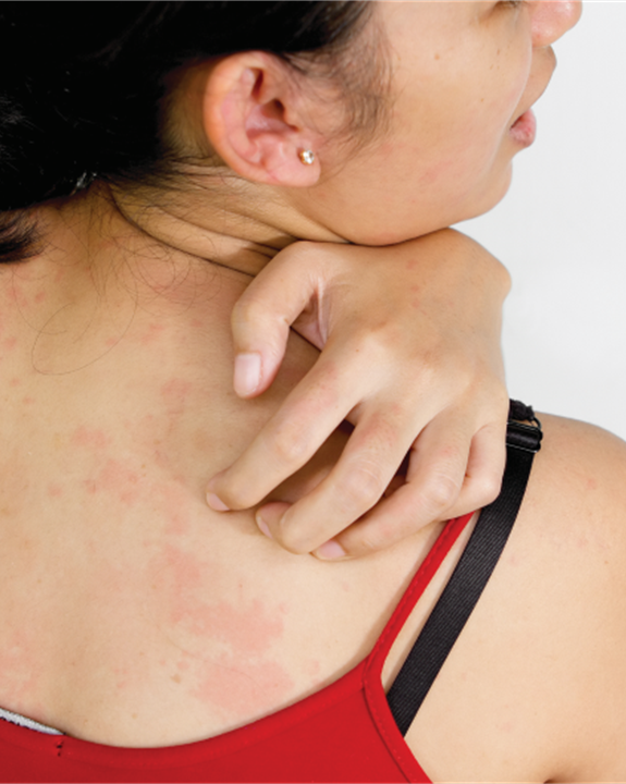 Urticaria Clinical Research