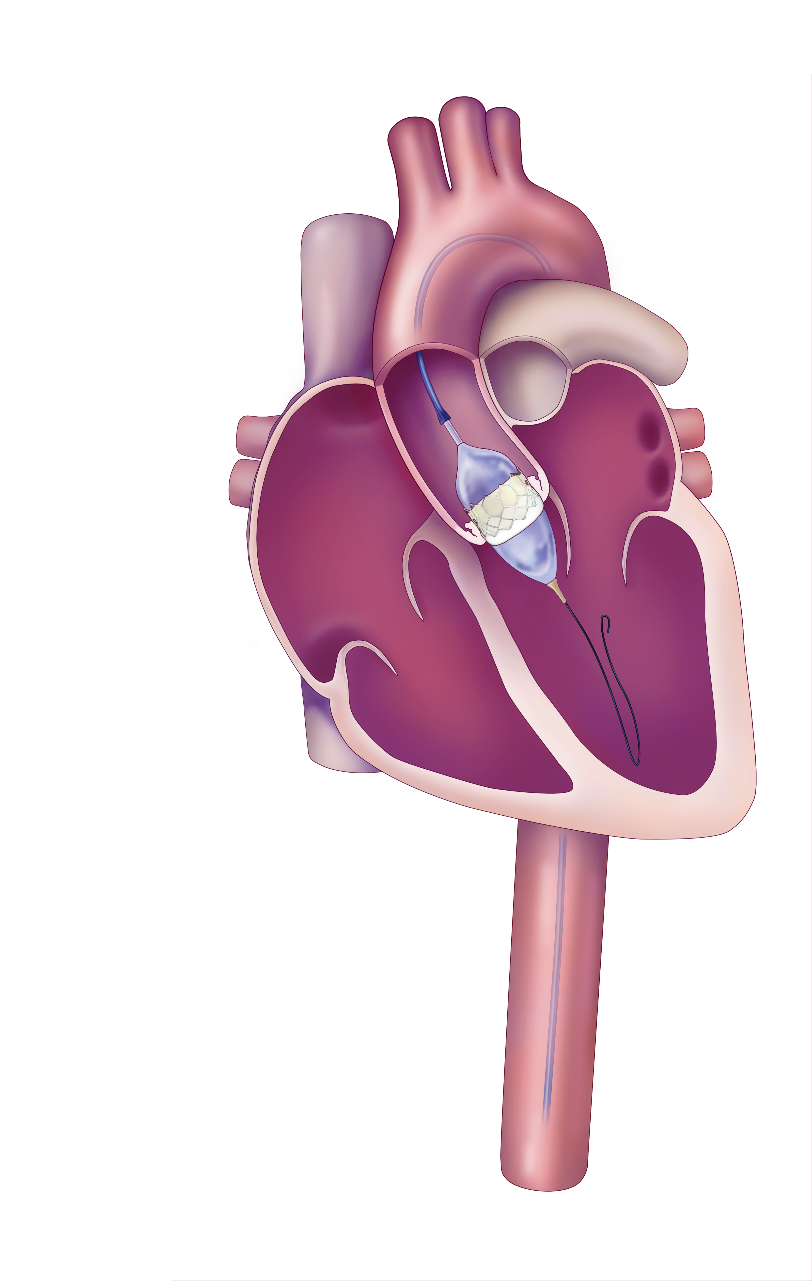 TAVR Device - Step 2