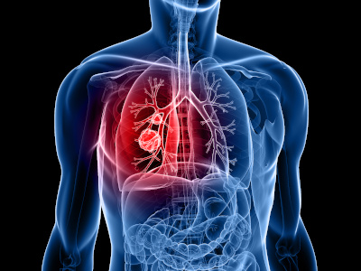 Lung Nodule Screenings - Respiratory/Pulmonary