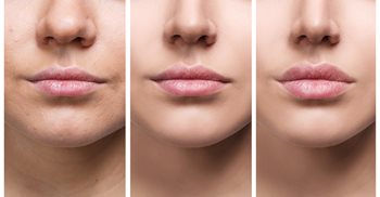Lip augmentation