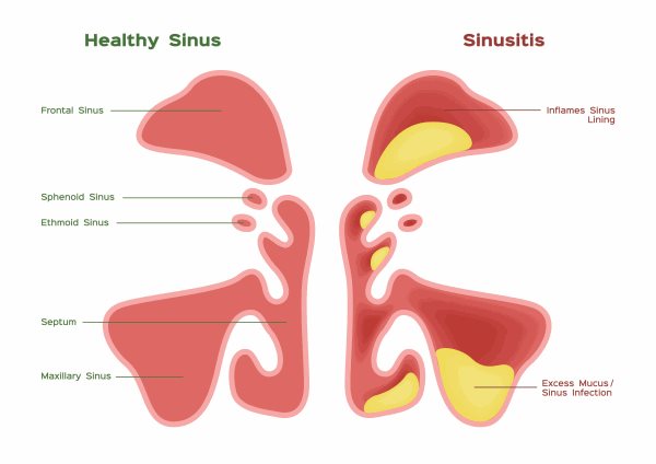 Deaconess Managing Treating Chronic Sinusitis