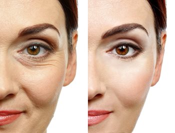 Facial Fillers